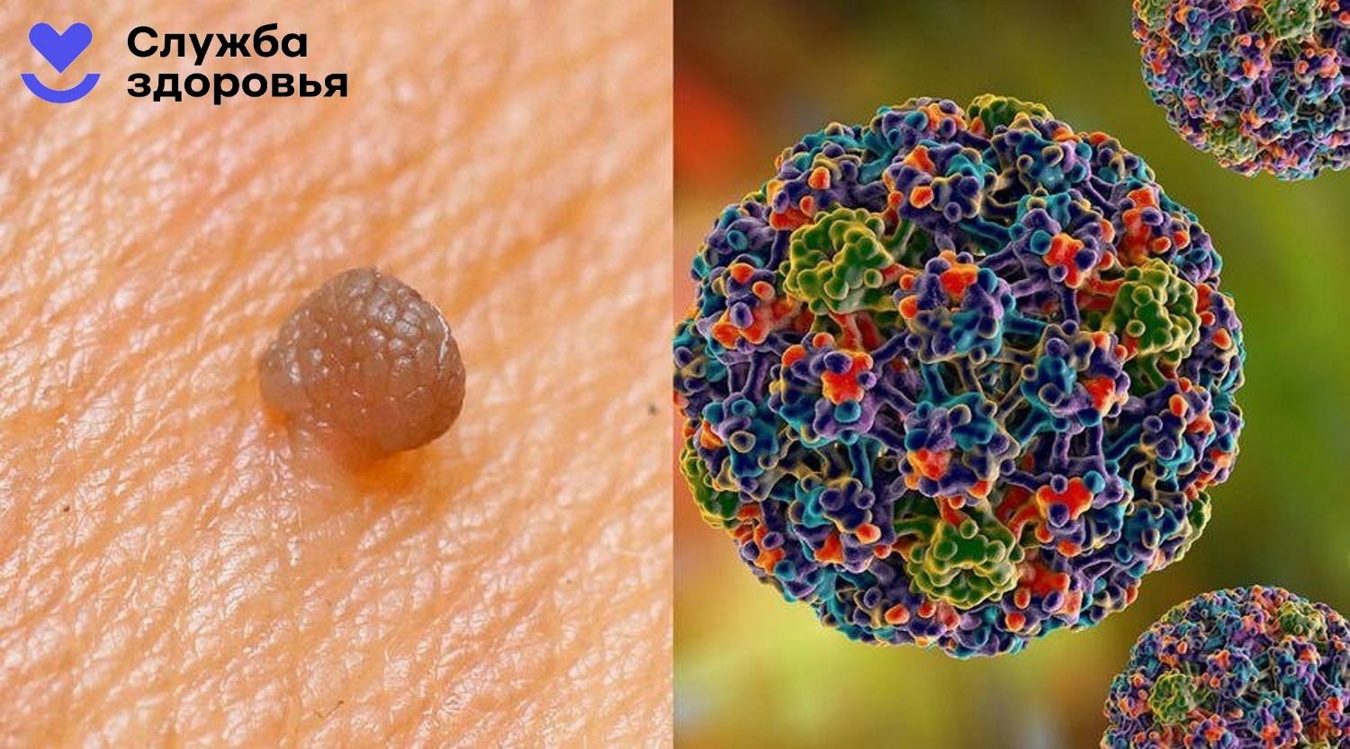 Папиломы вирус передается от человека к человеку. Возбудители папилломавирусной инфекции.
